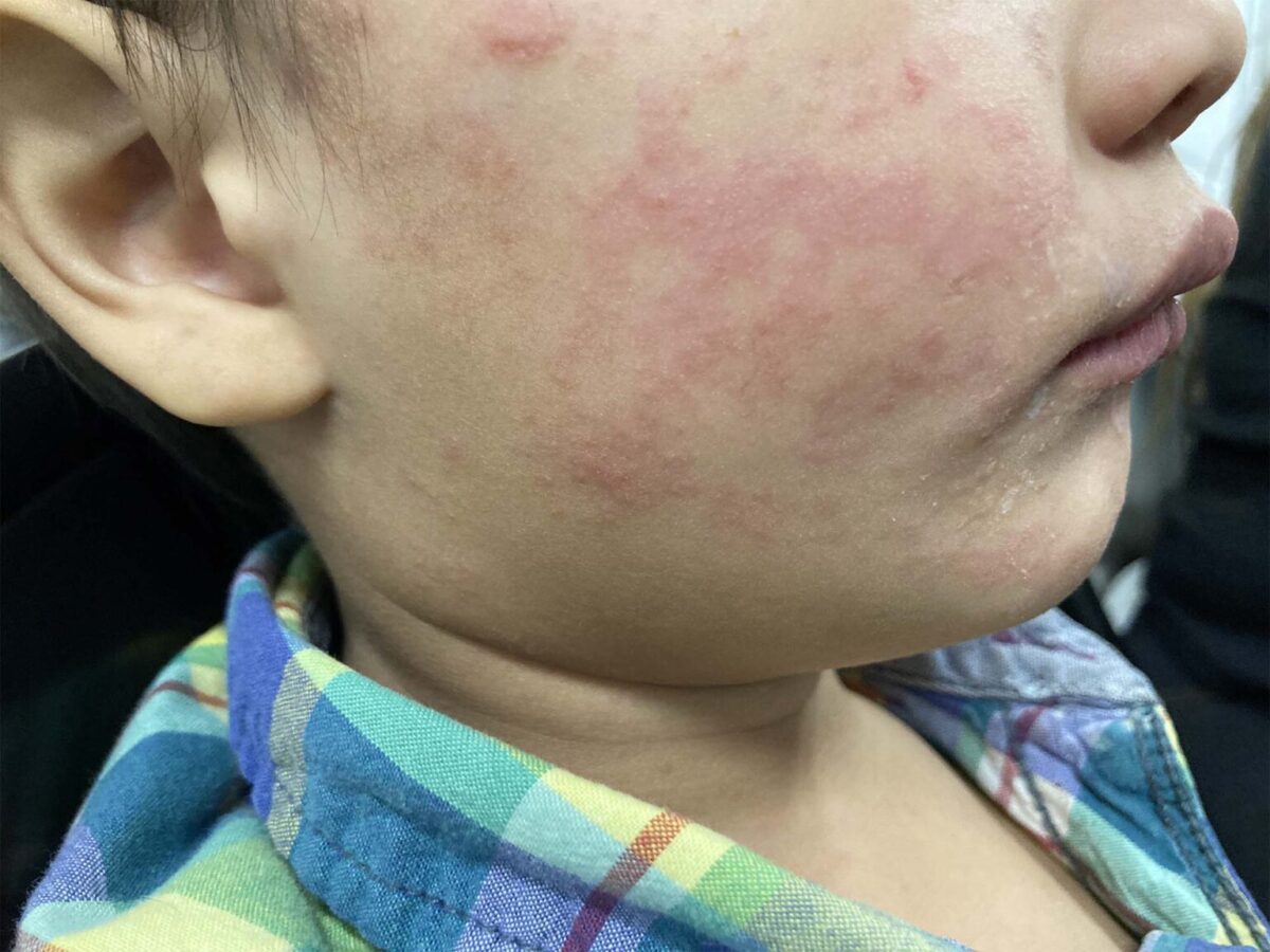 Me, Myself, as Mommy: Utah’s measles outbreak highlights frustrating times